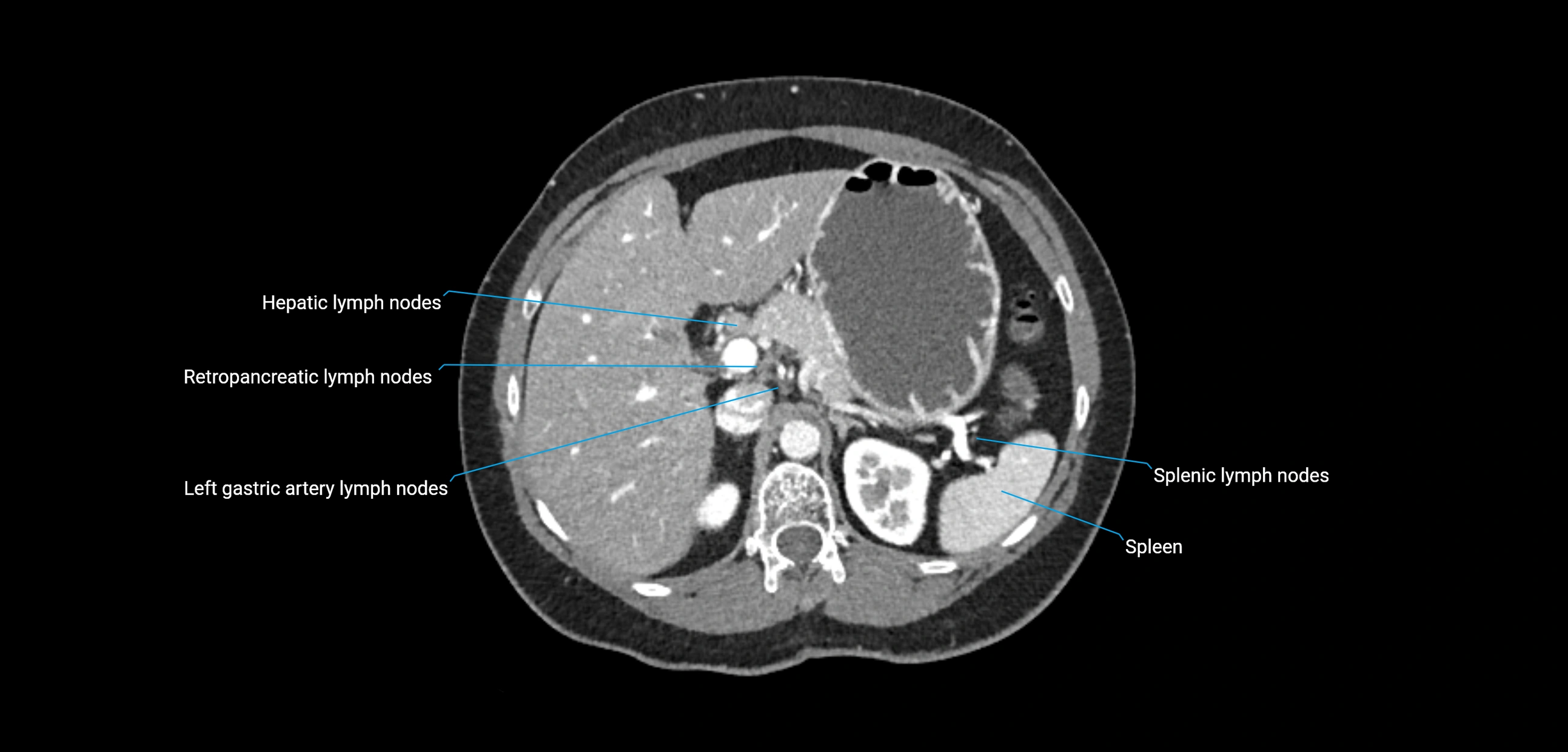 CT ct abdominal lymph nodes  axial cross sectional anatomy  enchanced radiology image -img-00002-00138.webp